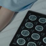 Stroke di Usia Produktif: Kenali Faktor Risiko Sebelum Terlambat